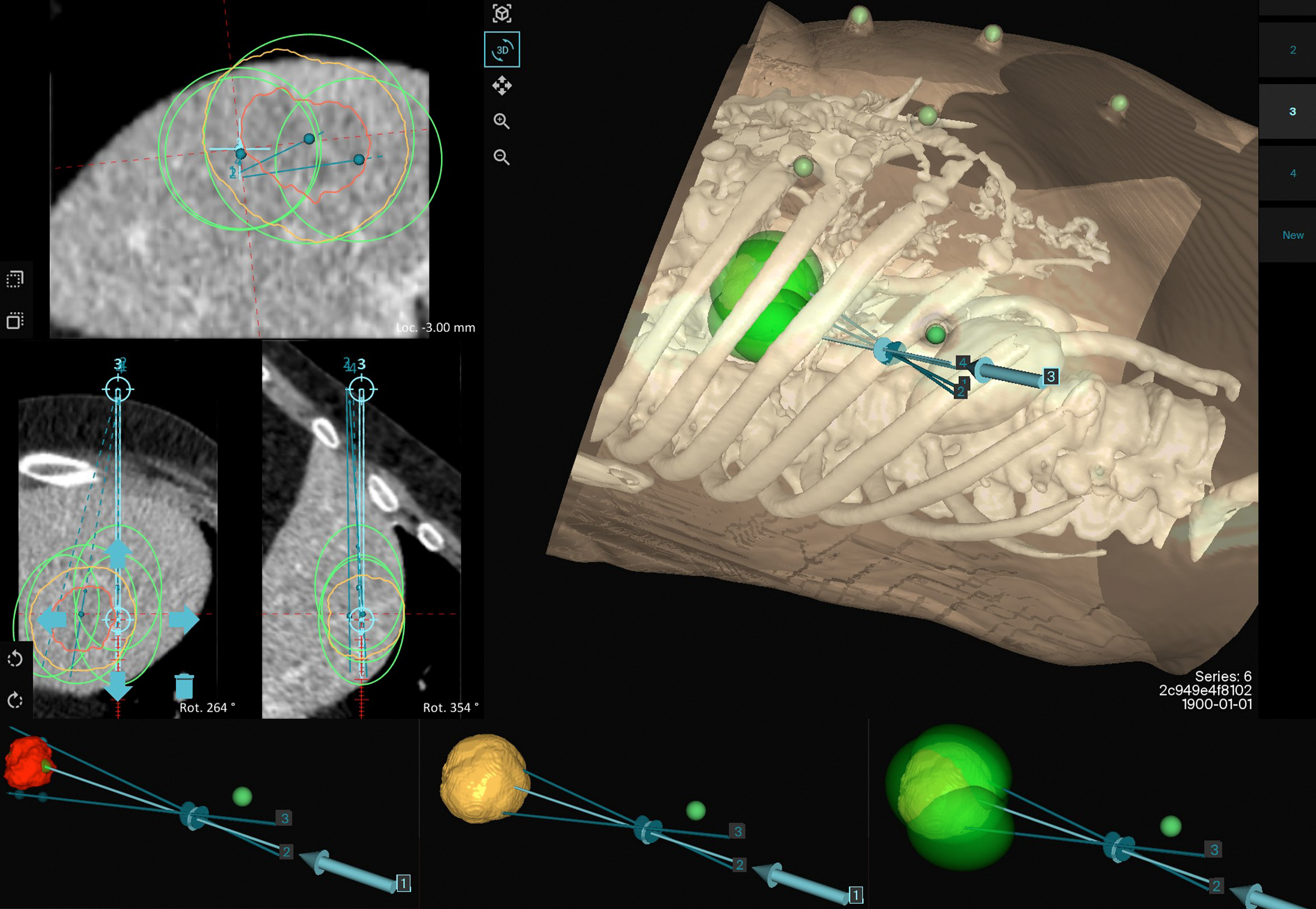 Multi-volume overlapping ablation zone of a large metastatic liver ...